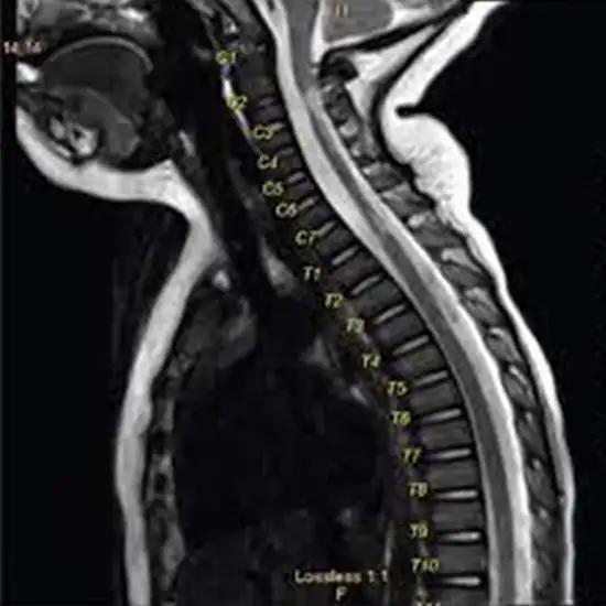 MRI Cervical Dorsal Spine